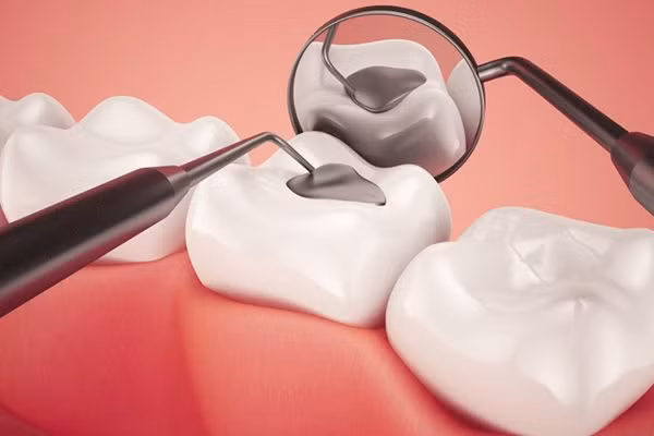 Các vết trám tồn tại được vài năm nhưng nó vẫn có thể bị mài mòn, mẻ hoặc ố màu. Ảnh: cloudfront.