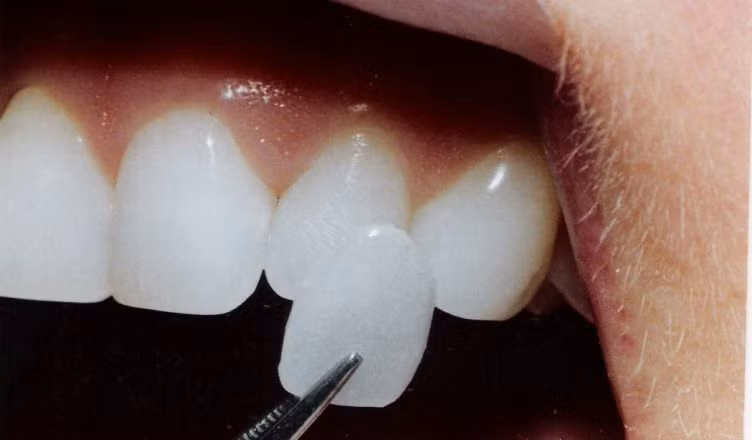 Mặt dán sứ Veneer là một lớp sứ cực mỏng, chỉ dày từ 0,5mm – 0,6mm, được dán vào mặt trước của răng để đem lại màu răng trắng sáng. Ảnh: nhakhoahanquoc.