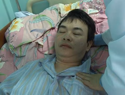 Cũng đang điều trị tại bệnh viện Nhiệt đới TW, bệnh nhân này được chẩn đoán viêm màng não mủ do nhiễm liên cầu khuẩn lợn.