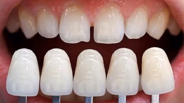  2 thứ phình to báo hiệu lão hóa - Khoảng cách giữa các răng lớn hơn Khoảng cách giữa các răng trở nên lớn hơn là một trong những dấu hiệu lão hóa đang đến gần. Theo các nhà khoa học, khi về già, collagen trong cơ thể sẽ hao hụt, lượng cơ trong người cũng teo dần khiến nướu có phản ứng co lại. Từ đó, chân răng có xu hướng ngày càng lộ ra ngoài, khe hở giữa các răng vì vậy mà lớn hơn.