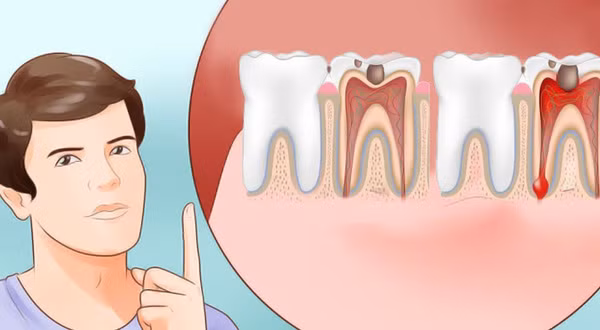 Chính vì vậy, nếu thấy dấu hiệu đau răng bất thường kèm đổ mồ hôi, da xanh xao, mệt mỏi kiệt sức thì nên đề phòng nhồi máu cơ tim cấp.