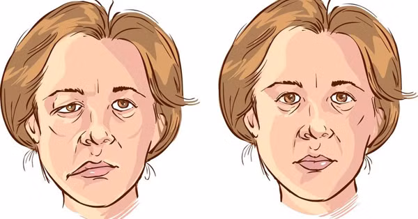 Dây thần kinh số VII còn có vai trò chi phối cơ vùng tai giữa liên quan đến chức năng tiếp nhận âm thanh và đảm nhiệm cảm nhận vị giác 2/3 trước lưỡi. Vì vậy, liệt dây thần kinh mặt sẽ gây ra các biểu hiệu mất cân bằng về chức năng cũng như thẩm mỹ của một nửa mặt.