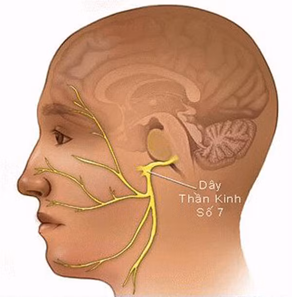 Nguyên nhân thứ phát thường diễn ra sau nhiễm siêu vi như Zona vùng hạch gối, chấn thương vỡ xương đá, u chèn ép, biến chứng của đái tháo đường hoặc các bệnh lý tự miễn.