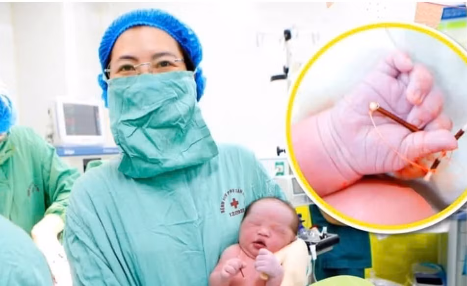 Bé trai nặng 3,8 kg chào đời cùng vòng tránh thai của mẹ Be trai nang 3,8 kg chao doi cung vong tranh thai cua me