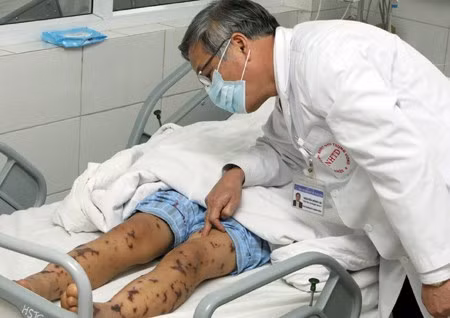 Hà Nội xuất hiện ca viêm màng não mô cầu đầu tiên Ha Noi xuat hien ca viem mang nao mo cau dau tien