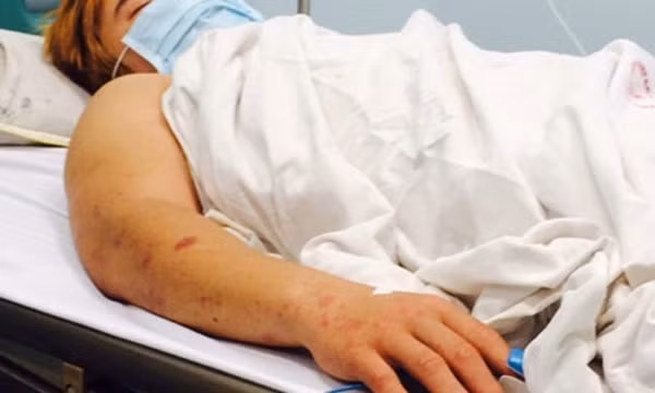 Hà Nội đang quyết liệt ngăn viêm màng não mô cầu bùng phát dịch Ha Noi dang quyet liet ngan viem mang nao mo cau bung phat dich