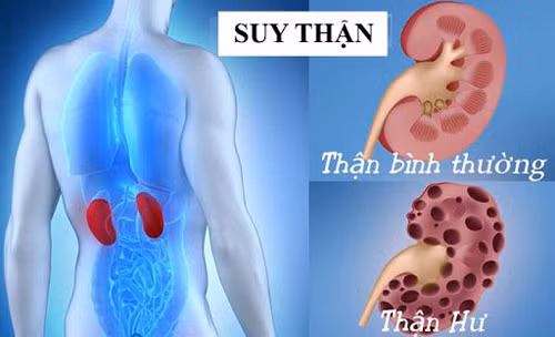 Điều đáng bàn, thói quen sinh hoạt không khoa học cùng các yếu tố môi trường khiến ngày càng có nhiều người mắc các bệnh về thận. Ở đó, suy thận là tình trạng thận bị mất chức năng, không còn khả năng lọc các chất thải từ máu. Điều này dẫn đến những chất thải trong máu không thể lọc ra ngoài và tích tụ lại trong cơ thể.