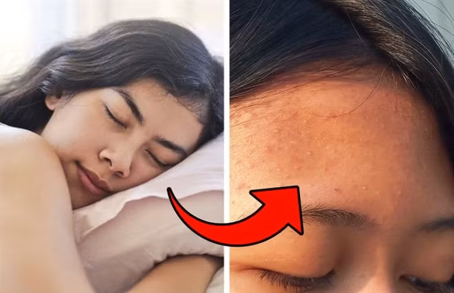 Khi bạn không thay quần áo ngủ, vi khuẩn và tế bào da chết sẽ tích tụ trong vải. Vào ban đêm, nó sẽ ép vào lỗ chân lông của bạn, bít các lỗ chân lông và gây mụn. Khi ngủ bạn hay đổ mồ hôi, đồ ngủ sẽ thấm mồ hôi và cũng làm da nổi mụn. 