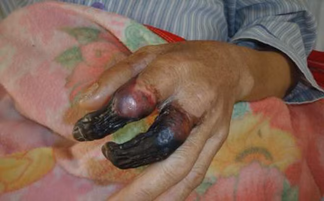 Bi vet xuoc nho, 8 ngay sau nguoi dan ong o Thai Binh can ke cai chet