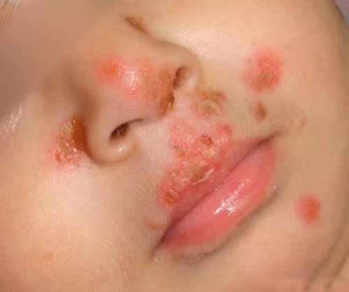 Trong đó, HSV tuýp 1 gây ra bệnh herpers miệng, môi còn HSV tuýp 2 gây ra bệnh herpers sinh dục và hậu môn. Tỷ lệ người chứa virus này khá lớn. Tại Mỹ, khoảng 70% người trưởng thành nhiễm HSV tuýp 1 trong khi HSV tuýp 2 phổ biến tới mức cứ 6 người thì có 1 đối tượng bị nhiễm.