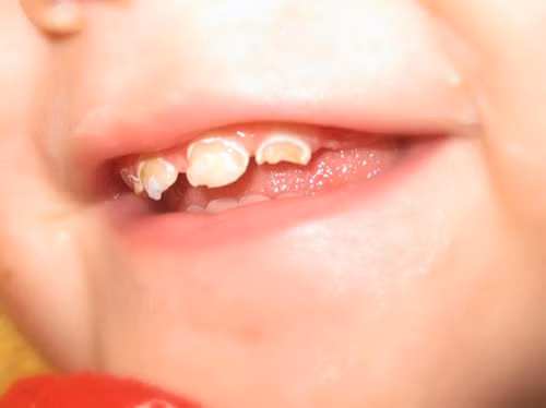 Tăng khả năng sâu răng. Hầu hết mọi người tin rằng sâu răng ở trẻ bắt nguồn từ việc vệ sinh kém mà không biết rằng nụ hôn môi có thể lây lan vi khuẩn Streptococcus mutans gây sâu răng thông qua tiếp xúc nước bọt.