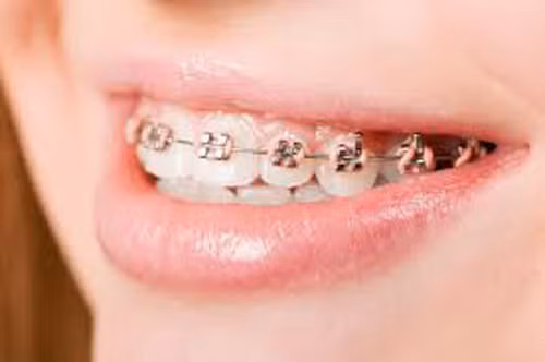Ở Mỹ, khoảng 60% dân số có bảo hiểm nha khoa song hầu hết các công ty bảo hiểm không chi trả cho các khoản liên quan đến niềng răng. Chỉ một vài công ty đồng ý chi trả thì số tiền cũng chỉ giới hạn trong 20% tổng chi phí ca niềng.