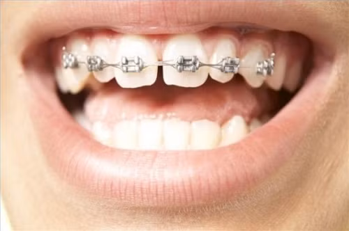 Trái lại, việc dùng dây thun, sợi chỉ tơ có thể mang lại hiệu quả song rủi ro cũng khá nhiều. Chỉ có chỉnh nha chuyên nghiệp mới là lựa chọn tốt nhất.