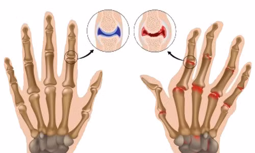 Viêm khớp dạng thấp chỉ ảnh hưởng đến các khớp xương? Ngoài các khớp xương, viêm khớp dạng thấp mãn tính còn ảnh hưởng đến các cơ quan khác như phổi, thần kinh, mắt.