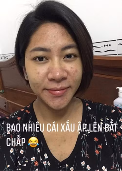 Da mặt của Hoa hậu Đại dương 2014 bị mụn chi chít. Ảnh: FBNV