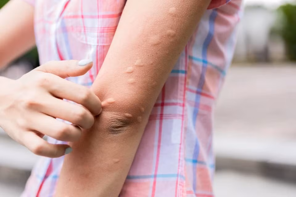 6 dấu hiệu cảnh báo sốt xuất huyết trở nặng 6 dau hieu canh bao sot xuat huyet tro nang