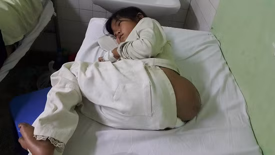 Đã cắt bỏ khối u khổng lồ cho em bé người vượn Da cat bo khoi u khong lo cho em be nguoi vuon