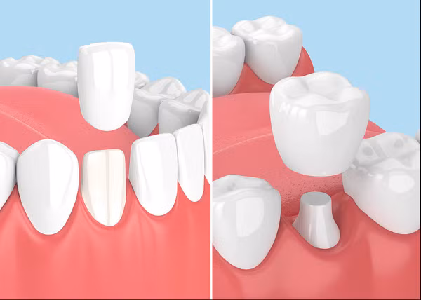 Tuy nhiên, bác sĩ nha khoa cho biết đây không phải các bước chuẩn bị tiêu chuẩn dành cho dán sứ veneer mà là cho bọc crown (bọc mão sứ), một quy trình không được khuyến khích thực hiện với các bạn trẻ.