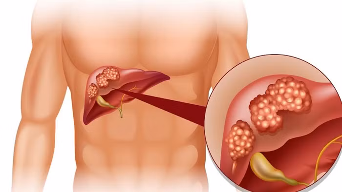 Khi gan bị tổn thương, chức năng giải độc sẽ giảm, độc tố tích tụ trong cơ thể cũng nhiều hơn, gây ra nhiều vấn đề khác nhau. Để tránh làm hại gan, bạn nên tránh làm những việc dưới đây vào buổi sáng.