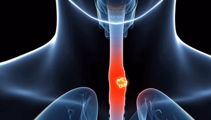 Phát hiện và điều trị kịp thời có ý nghĩa quan trọng quyết định thành công quá trình chữa trị. Tuy nhiên, bác sĩ khuyên nên phòng bệnh hơn chữa bệnh. Đặc biệt những nhóm người dưới đây.