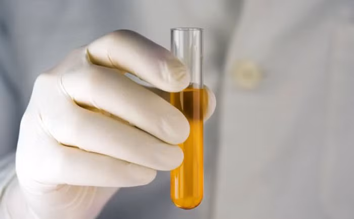 Nước tiểu màu vàng đậm. Người bị viêm gan do virus, xơ gan… nước tiểu thường có màu vàng sẫm, trường hợp nặng có thể có màu nâu đen. Tuy nhiên, ngoài là dấu hiệu bệnh gan, nước tiểu sẫm màu còn có thể do nguyên nhân khác gây ra như: viêm nhiễm đường tiết niệu, thiếu máu, tắc nghẽn ống mật....