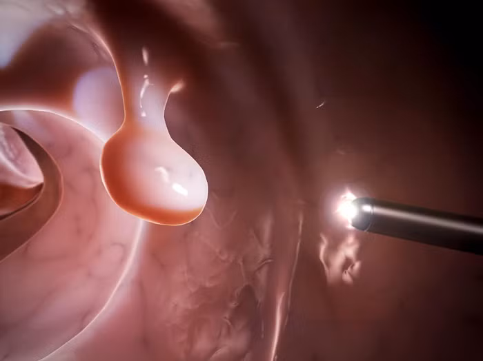 Polyp đại tràng ít có triệu chứng song bạn có thể nhận diện nó nếu xuất hiện máu dính ở đồ lót hoặc giấy vệ sinh sau khi đi cầu, táo bón hoặc tiêu chảy kéo dài không rõ nguyên nhân, thay đổi màu phân, đau bụng, buồn nôn...