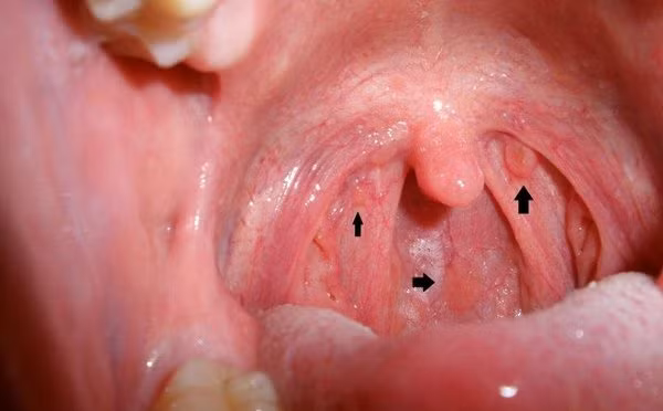Thế nhưng, nếu triệu chứng lở loét miệng diễn ra thường xuyên thì chứng tỏ nó đã kháng lại nhiều loại thuốc và vi khuẩn có lợi, nếu không chú ý thì chúng ta có thể mắc bệnh ung thư miệng, cực kỳ nguy hiểm.