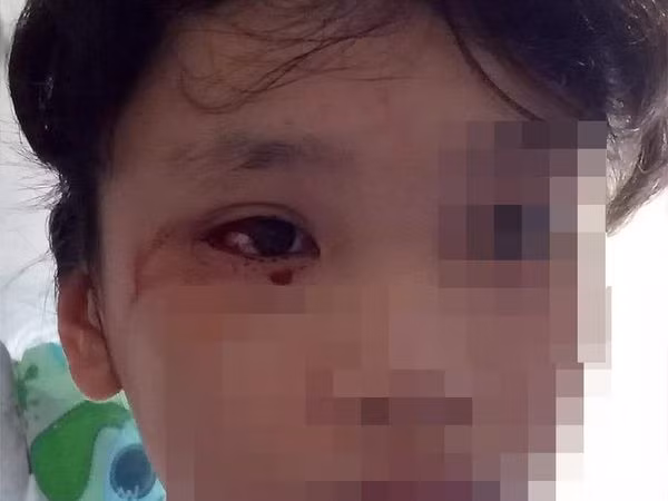 Hoc truc tuyen 8 tieng/ngay, be gai 12 tuoi chay mau mat o at