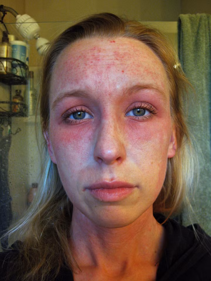 Bệnh nặng khiến cô ho ra máu, vì vậy mà bác sỹ phải kê đơn liều steroid (một loại giảm đau chống viêm) cao để trị bệnh. Sau khi uống steroid thì khắp cơ thể của Beth xuất hiện những vùng da đỏ ửng, đầy nốt đỏ li ti.