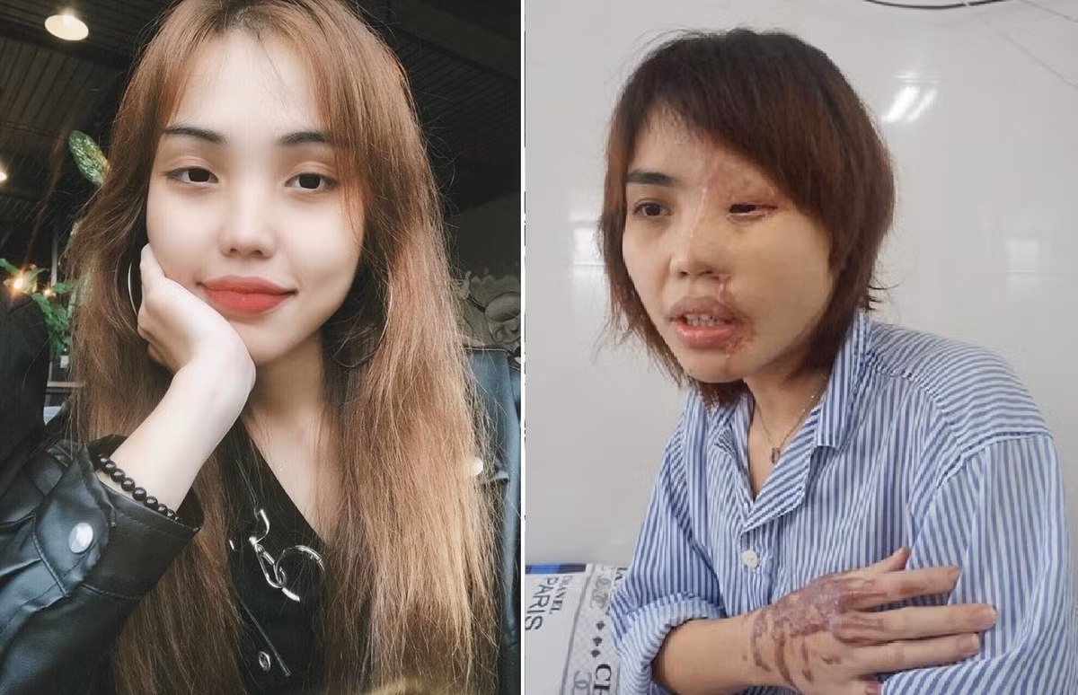 Từ một cô gái có vẻ ngoài xinh đẹp, Vy bị chồng sắp cưới là thiếu úy công an tạt axit khiến khuôn mặt biến dạng.