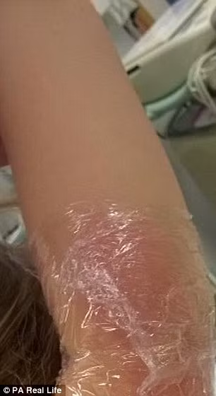 Các bác sĩ phải lấy da ở đùi để che vết thương trên lưng và cánh tay bé. 