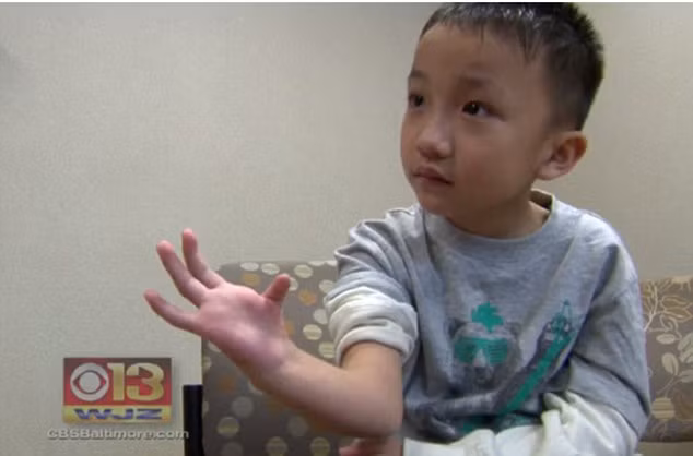 Lal Ding, hiện sống tại Baltimore (Mỹ) bẩm sinh đã mang bàn tay thiếu ngón vì loạn sản xương quay, một bệnh về gien hiếm gặp khiến xương quay (xương nối giữa khuỷu tay với cánh tay) không được hình thành như bình thường. Vì vậy Lal chỉ có một mảnh xương nhỏ trên cánh tay. 