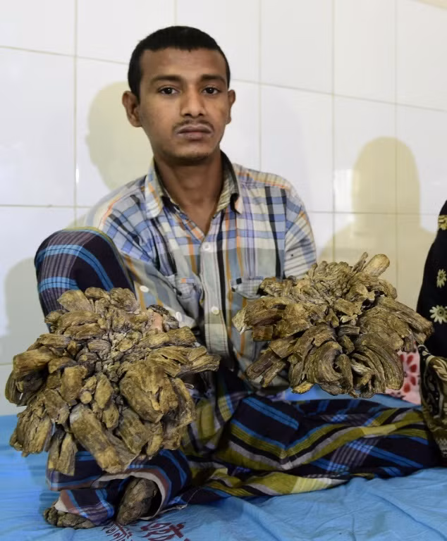 Một người đàn ông Bangladesh mang biệt danh “ người cây” vì những mụn cóc sần sùi như vỏ cây đã được điều trị và bác sĩ hy vọng có thể cứu anh ta thoát khỏi cảnh khổ sở này. 