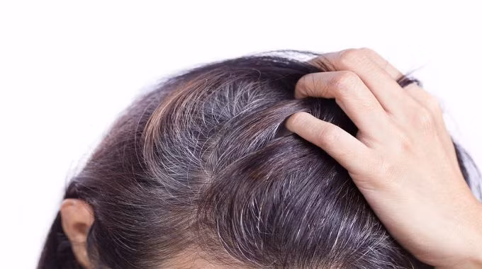 Tóc bạc sớm là do gien: Nếu ông bà, bố mẹ bạn bị tóc bạc sớm thì khả năng là bạn cũng bị tương tự. Đây là lý do vì sao một số người ngoài 20 tóc đã bạc, còn những người khác thì 50 tuổi tóc vẫn đen. 