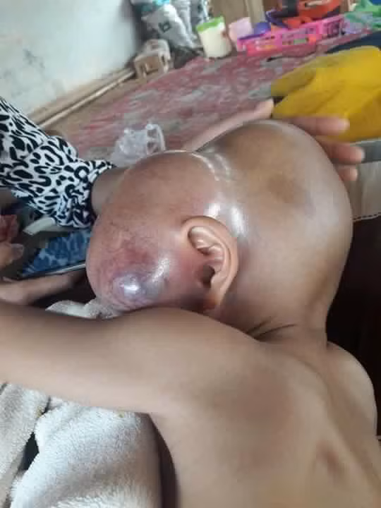 Kể từ đó bé Khondej đã trải qua 7 lần hóa trị tĩnh mạch nhưng không thể trừ tiệt khối u. 