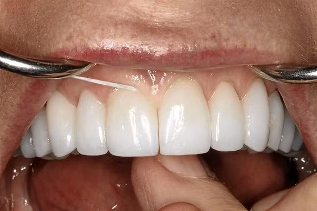 Nhưng các bác sĩ nha khoa cảnh báo rằng những phương pháp chỉnh răng này đều không chuyên nghiệp và khiến sức khỏe răng miệng của bạn gặp nguy hiểm. Những phương pháp chỉnh răng được hướng dẫn qua internet gồm có: 