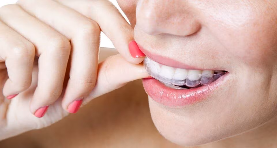 Nhìn trên bề mặt thì răng và nướu trông khỏe mạnh nhưng vấn đề có thể nằm ở bên dưới. Kể cả nếu không có những sợi chun bằng cao su tưởng có thể khiến cho răng bớt thưa sẽ siết chặt phần chân răng khiến răng có khả năng bị rụng.(Nguồn ảnh: Wiki)