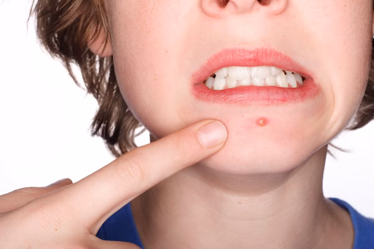 Dầu đinh hương được chứng minh là có tác dụng mạnh trong điều trị trứng cá nếu bôi vào vùng da bị mụn nên thường được dùng làm mặt nạ và kem mát xa trị mụn. Tinh dầu từ hoa đinh hương có đặc tính làm sạch, loại bỏ vi khuẩn, giảm viêm sưng. Vì có đặc tính gây tê nên khi dùng phải pha với tỉ lệ 1:10 cùng với dầu dẫn khác để không bị kích ứng. 