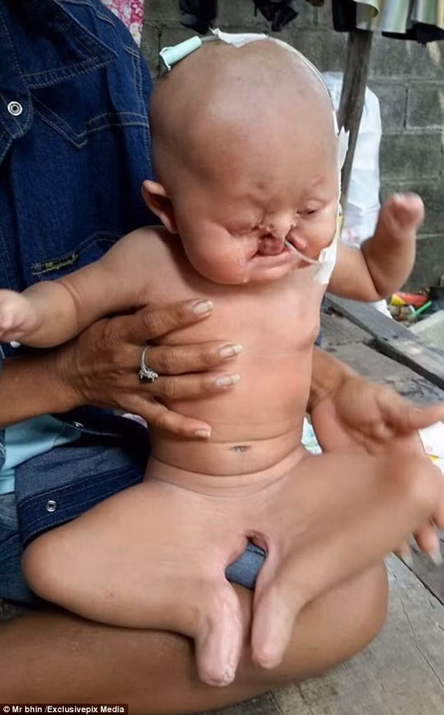 Thuong tam em be nguoi ca chan dinh lien, mu mot mat