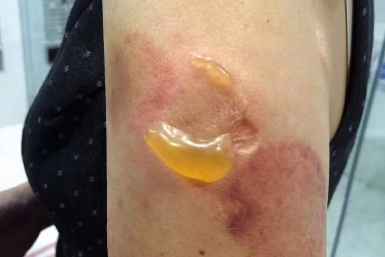 Bỏng độ 3 chỉ vì đắp lá ngải cứu chữa bệnh Bong do 3 chi vi dap la ngai cuu chua benh