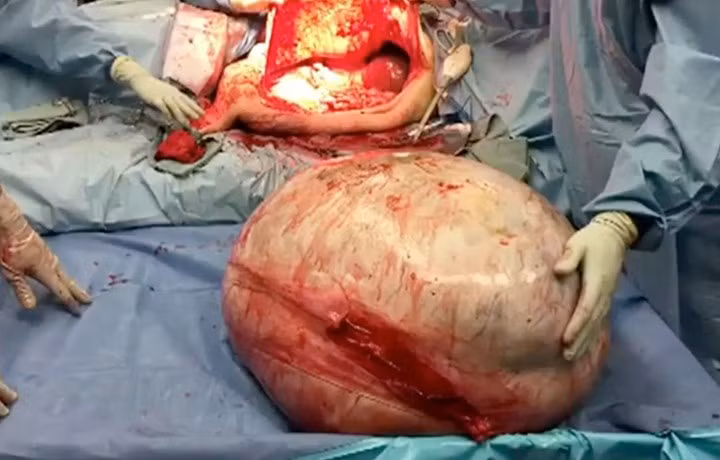 Sau phẫu thuật trọng lượng của bà Mary giảm từ 130kg xuống còn dưới 55kg. Tổng trọng lượng mà bà giảm được là gần 75kg. 