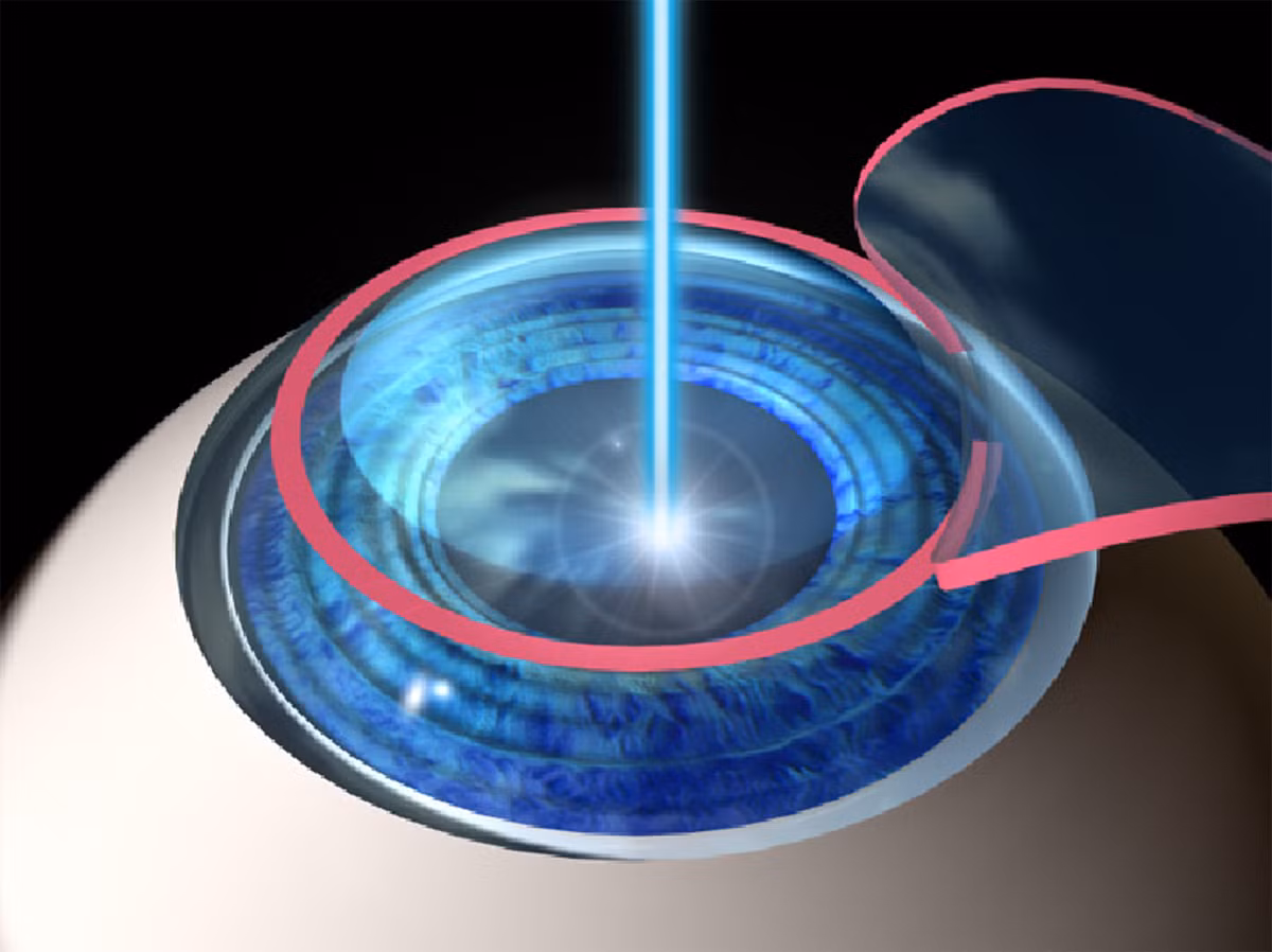 Sau khi phẫu thuật LASIK, võng mạc mắt bị mỏng đi và dễ nhiễm khuẩn nhưng nguy cơ nhiễm khuẩn keratitis khi đeo kính áp tròng còn cao hơn. Nghiên cứu còn phát hiện ra nhiễm trùng võng mạc khi đeo kính áp tròng loại có thời gian sử dụng dài cao hơn khi đeo loại có hạn sử dụng một ngày. 