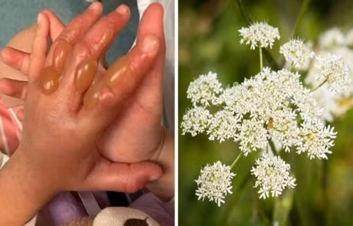 Hè đi chơi vô tình chạm vào cây này, bé gái bỏng cấp 3 He di choi vo tinh cham vao cay nay, be gai bong cap 3