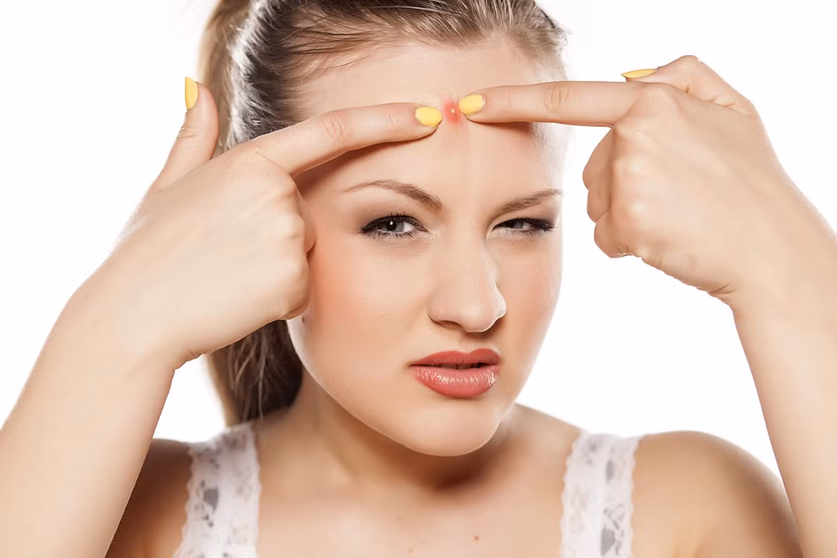 Các sản phẩm tạo kiểu tóc mà chúng ta sử dụng, như gel, sáp vuốt tóc hoặc dầu tóc cũng có thể là lý do gây ra mụn trên trán. Ảnh: naturalbeautycream.