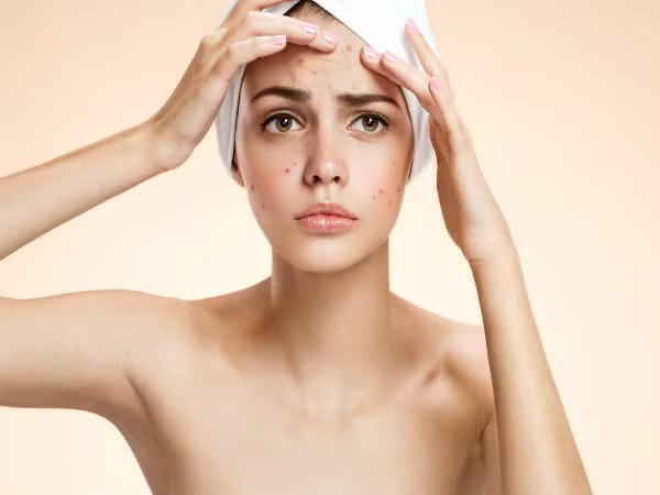 Một trong những nguyên nhân khiến mụn trứng cá trên trán xuất hiện nhiều đó chính là do lỗ chân lông bị tắc nghẽn. Ảnh: boldsky.