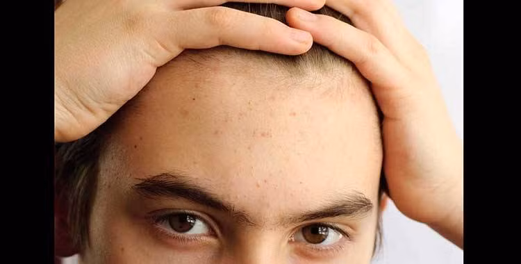 Thay đổi nội tiết tố và căng thẳng có thể làm gia tăng sản xuất dầu của da và điều này dẫn đến lỗ chân lông bị tắc, khiến mụn xuất hiện. Ảnh: tosshub.