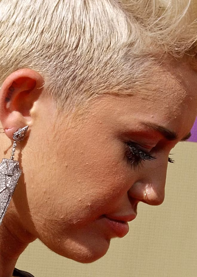Miley Cyrus thỉnh thoảng đối mặt với làn da "bất hợp tác" của mình. Nhiều người cho rằng ăn quá nhiều thực phẩm giàu dinh dưỡng sẽ dễ bị mụn trứng cá. Nhưng thực chất, một chế độ ăn giàu đạm, rau củ quả, ngũ cốc nguyên chất lại vô cùng có lợi cho sức khỏe và làn da.
