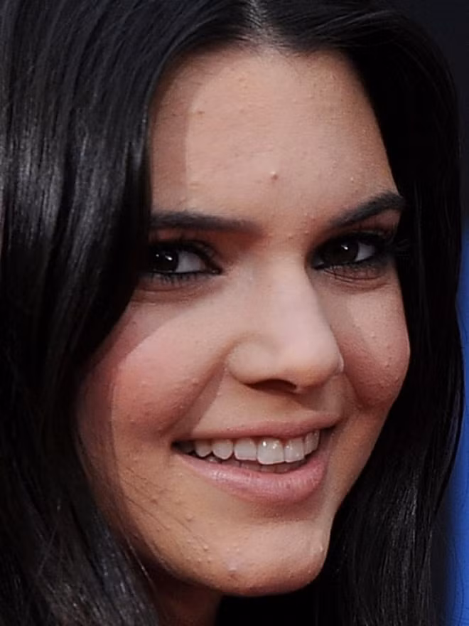 Ngoài Kendall, trước đó cũng có nhiều đại mỹ nhân Hollywood vướng phải tình trạng tương tự. Một trang tin về sức khỏe thậm chí còn liệt kê ra tình trạng da của các sao và tư vấn cách chữa trị phù hợp.