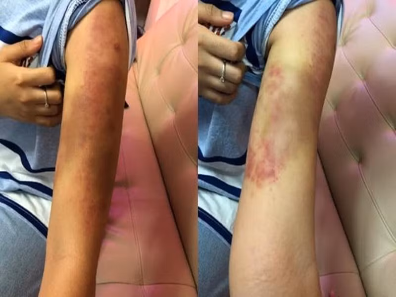 Nữ ca sĩ Phương Mỹ Chi tìm đến việc giảm cân tiêu cực. Cô uống thuốc giảm cân cấp tốc không rõ nguồn gốc khiến dạ dày bị co thắt. Phương Mỹ Chi còn móc họng ói, uống nước thay cơm khiến bị bệnh trào ngược dạ dày và xước cuống họng. Nữ ca sĩ còn áp dụng phương pháp “nào nhặn đốt mỡ” khiến hai bắp tay tím đen suốt 2 tháng. Ảnh: Tiền Phong
