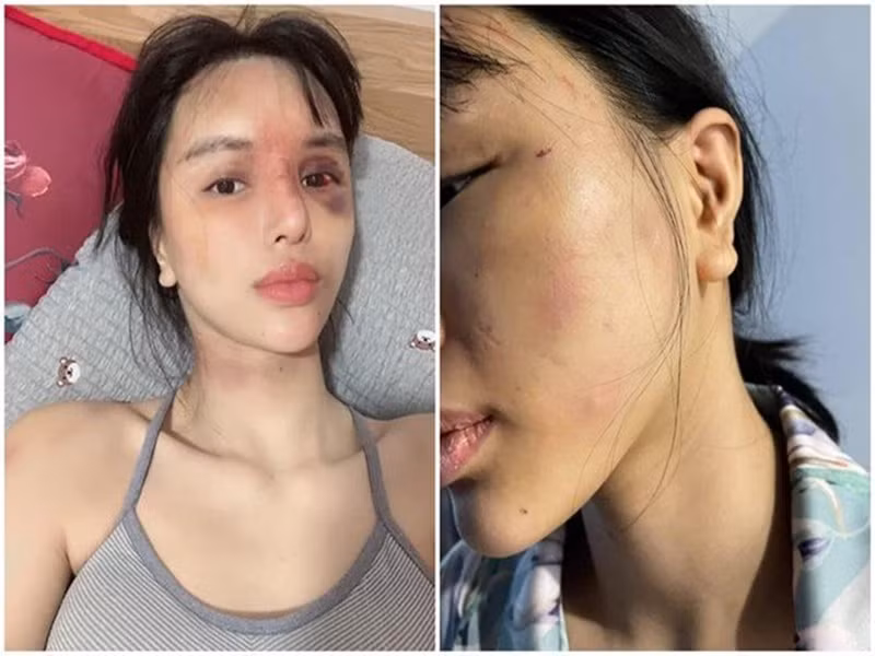 Mới đây, trên trang cá nhân, siêu mẫu Khả Trang đăng ảnh bầm tím khắp người. Ảnh: Sức khỏe và đời sống